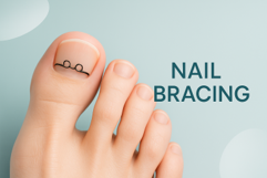 NAIL BRACING